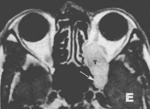 二、眼眶腦膜瘤